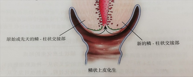 宮頸癌篩查沒那么簡單，這些技巧助你提高取樣質(zhì)量
