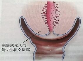 宮頸癌篩查沒那么簡單，這些技巧助你提高取樣質(zhì)量